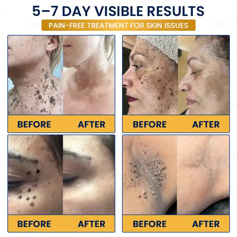 Celsiora® 7-Day MicroNeedle Skin Tag & Wart Removal Patch