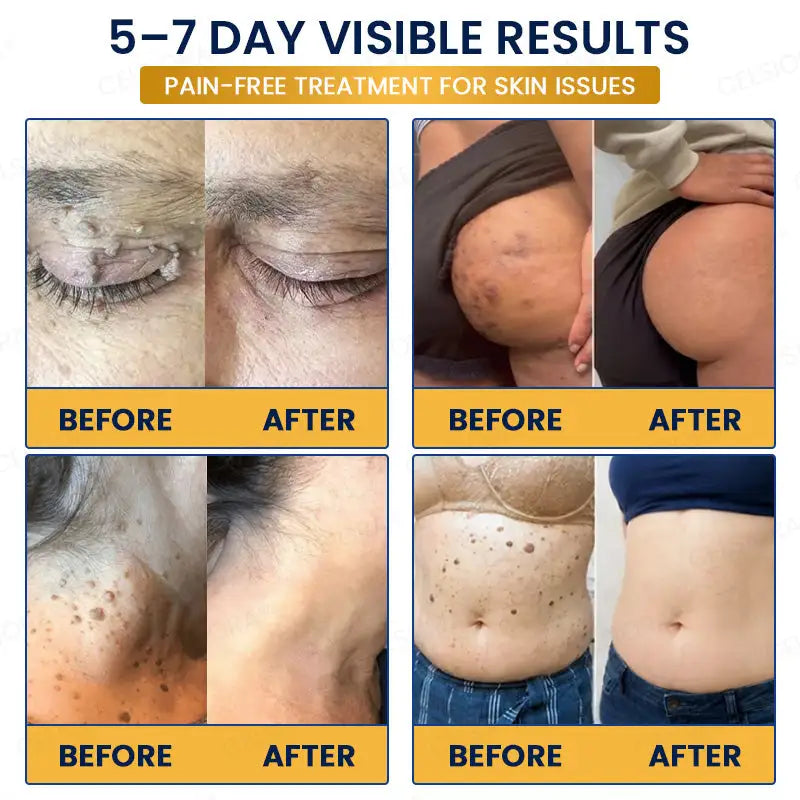 Celsiora® 7-Day MicroNeedle Skin Tag & Wart Removal Patch