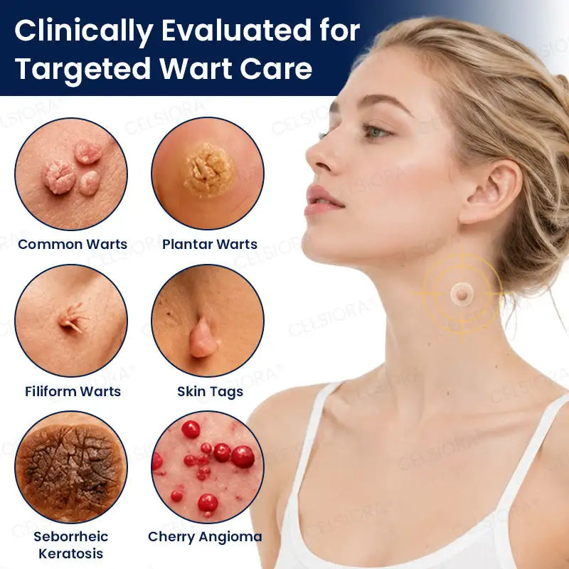 Celsiora® 7-Day MicroNeedle Skin Tag & Wart Removal Patch