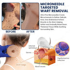 Celsiora® 7-Day MicroNeedle Skin Tag & Wart Removal Patch