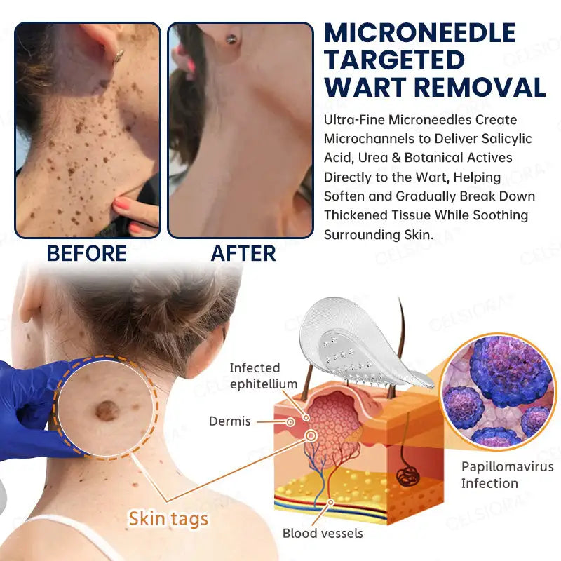 Celsiora® 7-Day MicroNeedle Skin Tag & Wart Removal Patch