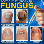 CareBreeze® FungiFree Bee Venom Nail Treatment